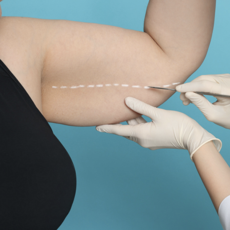 Free Liposuction Pricing Evaluations in McLean VA